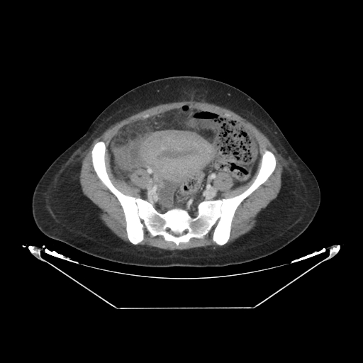Abdominal gossypiboma- surgical towel (Radiopaedia 57288-64226 Axial C+ portal venous phase 57).jpg