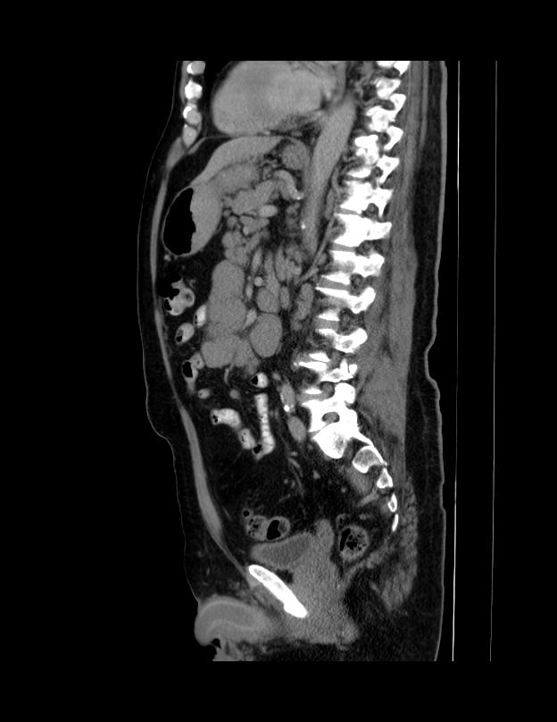 Abdominal lymphoma - with sandwich sign (Radiopaedia 53486-59492 Sagittal C+ portal venous phase 34).jpg