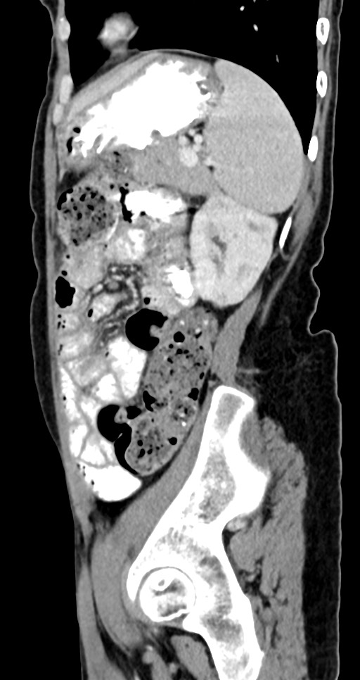 Abdominal wall and retroperitoneal tuberculosis (Radiopaedia 88137-104729 Sagittal C+ portal venous phase 43).jpg
