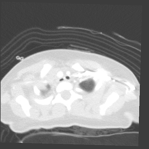 File:Aberrant left pulmonary artery (pulmonary sling) (Radiopaedia 42323-45435 Axial lung window 3).jpg