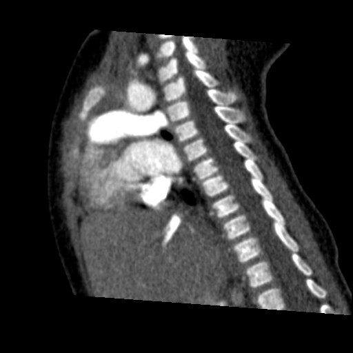 File:Aberrant left pulmonary artery (pulmonary sling) (Radiopaedia 42323-45435 Sagittal C+ arterial phase 27).jpg
