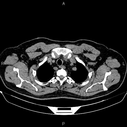 Aberrant right subclavian artery (Radiopaedia 87093-103354 Axial non-contrast 16).jpg