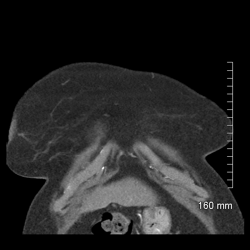 File:Aberrant right subclavian artery stenosis (Radiopaedia 52656-58670 B 14).jpg