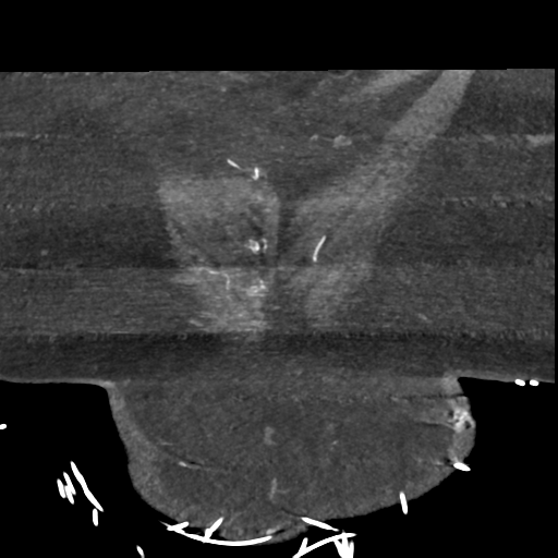 File:Aberrant right subclavian artery with Kommerell diverticulum (Radiopaedia 47982-52769 Coronal C+ arterial phase 4).png
