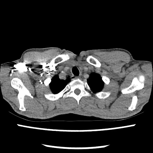 Accessory left horizontal fissure with lingular pneumonia (Radiopaedia 53763-59843 Axial C+ CTPA 11).jpg