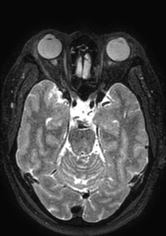 Accessory middle cerebral artery (Radiopaedia 73114-83828 Axial T2 127).jpg