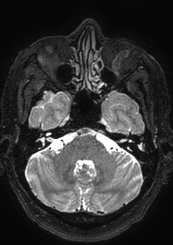 File:Accessory middle cerebral artery (Radiopaedia 73114-83828 Axial T2 163).jpg