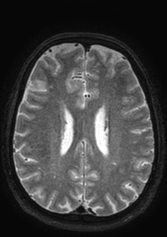 Accessory middle cerebral artery (Radiopaedia 73114-83828 Axial T2 18).jpg