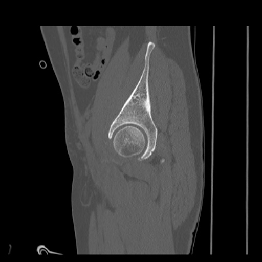 Acetabular and ilial fractures (Radiopaedia 59084-66378 Sagittal bone window 27).jpg