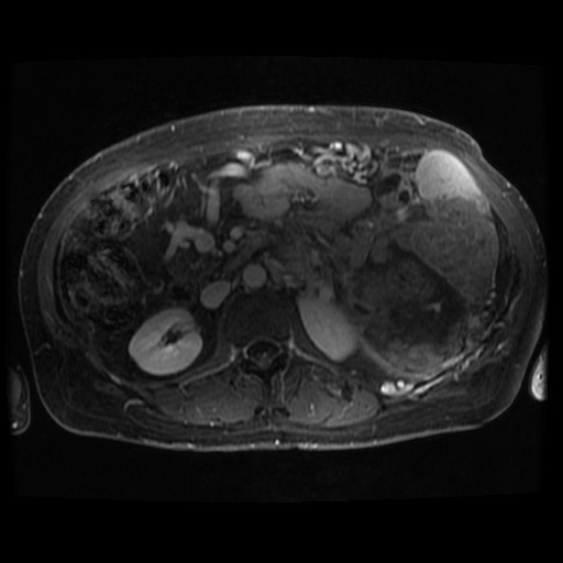 Acinar cell carcinoma of the pancreas (Radiopaedia 75442-86668 Axial T1 C+ fat sat 39).jpg