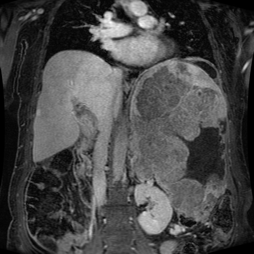File:Acinar cell carcinoma of the pancreas (Radiopaedia 75442-86668 Coronal T1 C+ fat sat 93).jpg