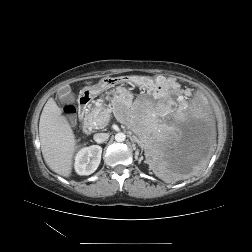 File:Acinar cell carcinoma of the pancreas (Radiopaedia 75442-86669 Axial C+ portal venous phase 49).jpg
