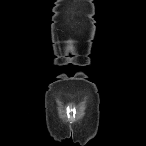 Acinar cell carcinoma of the pancreas (Radiopaedia 75442-86669 Coronal C+ portal venous phase 123).jpg