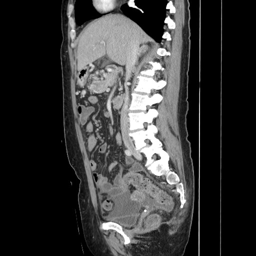 Acinar cell carcinoma of the pancreas (Radiopaedia 75442-86669 Sagittal C+ portal venous phase 87).jpg