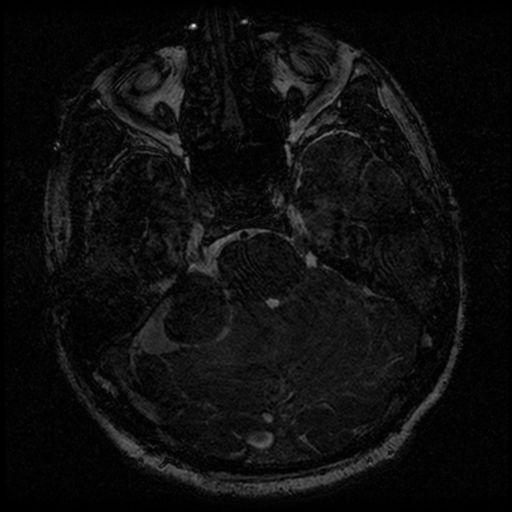 File:Acoustic schwannoma (Radiopaedia 39170-41387 Axial FIESTA 85).png