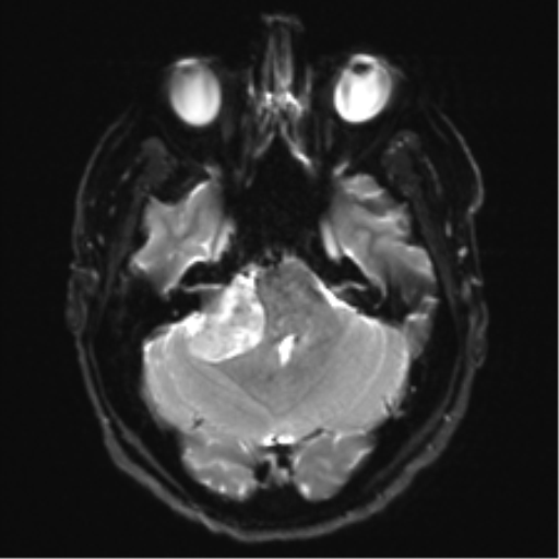 Acoustic schwannoma (Radiopaedia 50846-56358 Axial DWI 8).png