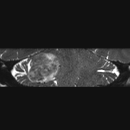 File:Acoustic schwannoma (Radiopaedia 50846-56358 Coronal T2 16).png