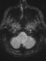 Acoustic schwannoma (Radiopaedia 55729-62281 Axial SWI 5).png