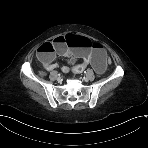 File:Active Crohn disease (Radiopaedia 59394-66750 Axial C+ portal venous phase 53).jpg