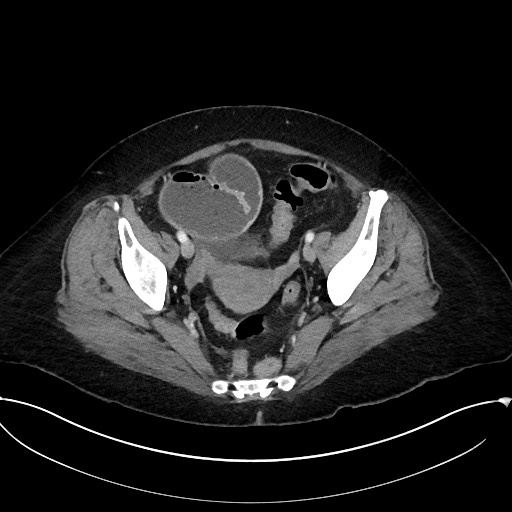 Active Crohn disease (Radiopaedia 59394-66750 Axial C+ portal venous phase 61).jpg