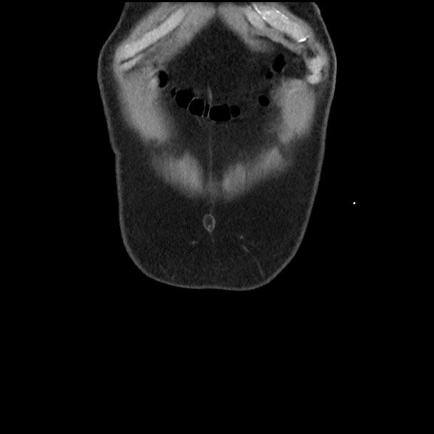 Active colonic bleed on CT (Radiopaedia 49765-55025 Coronal non-contrast 7).jpg