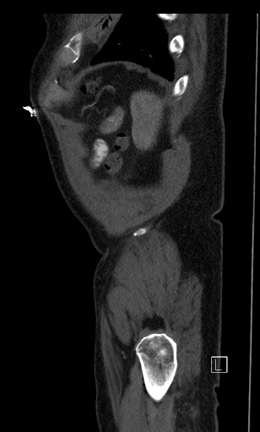 Active lower gastrointestinal bleeding - diverticular (Radiopaedia 61203-69106 Sagittal C+ arterial phase 12).jpg