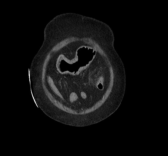 Active renal extravasation with large subcapsular and retroperitoneal hemorrhage (Radiopaedia 60975-68796 Coronal C+ portal venous phase 25).jpg