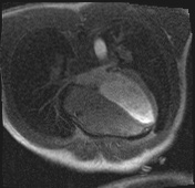 Active right ventricular cardiac sarcoidosis (Radiopaedia 55596-62100 Axial Dynamic perfusion scan MOCO 76).jpg