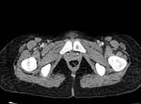 Acute Budd-Chiari syndrome (Radiopaedia 60858-68638 A 307).jpg