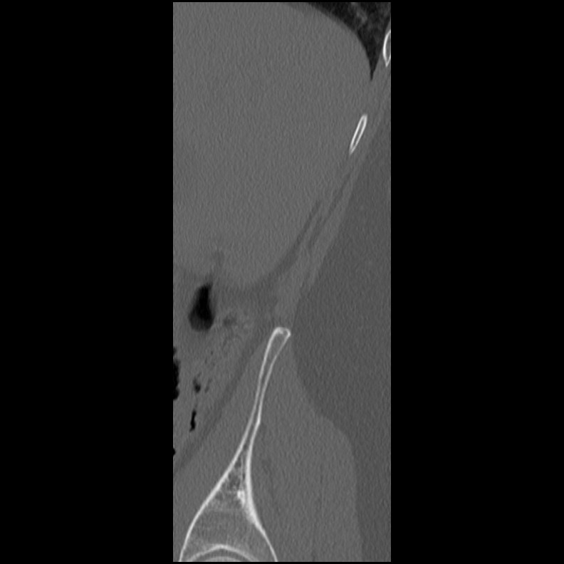Acute Schmorl's node (Radiopaedia 83276-102365 Sagittal bone window 83).jpg