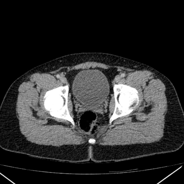 Acute appendicitis (Radiopaedia 38255-40270 Axial C+ portal venous phase 104).jpg