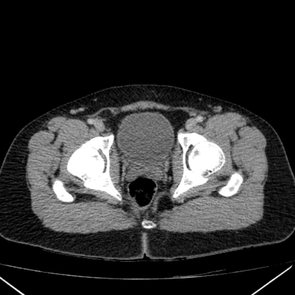 Acute appendicitis (Radiopaedia 38255-40270 Axial C+ portal venous phase 106).jpg