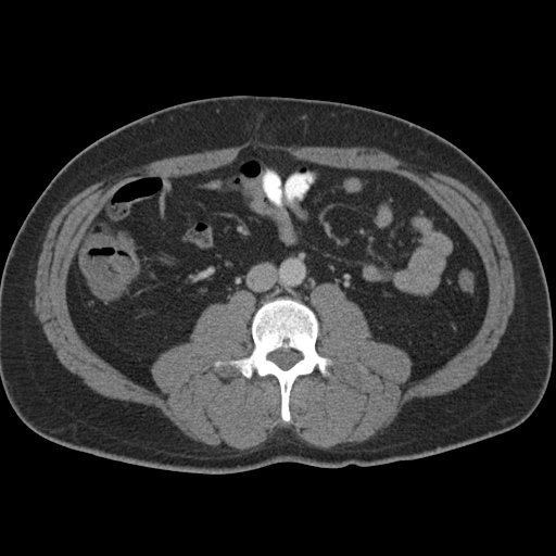 Acute appendicitis (Radiopaedia 48511-53463 Axial C+ portal venous phase 54).jpg