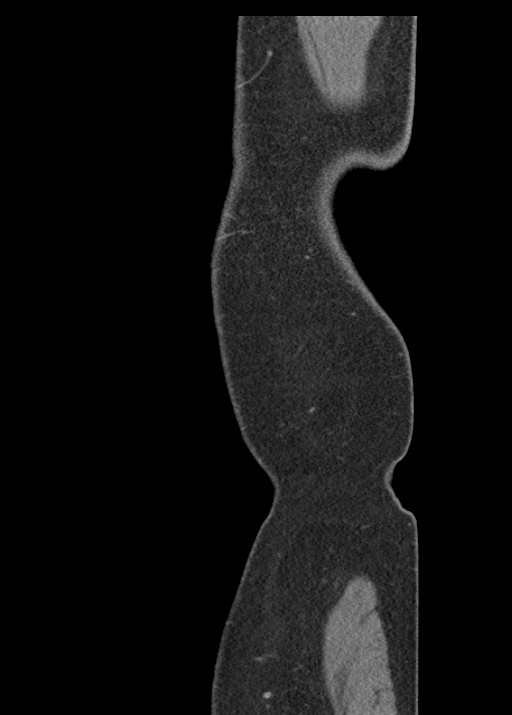 Acute appendicitis (Radiopaedia 48511-53463 Sagittal C+ portal venous phase 131).jpg