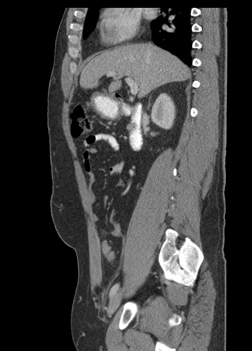 Acute appendicitis (Radiopaedia 48511-53463 Sagittal C+ portal venous phase 57).jpg