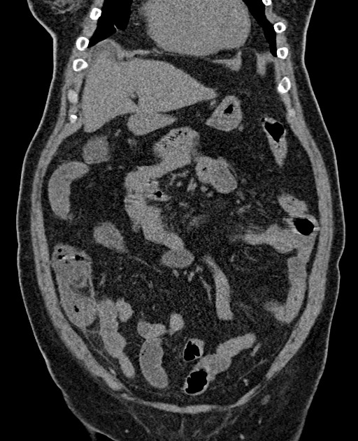 Acute appendicitis (Radiopaedia 58627-65818 Coronal non-contrast 30).jpg