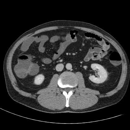 Acute appendicitis (Radiopaedia 66513-75790 Axial C+ portal venous phase 35).jpg