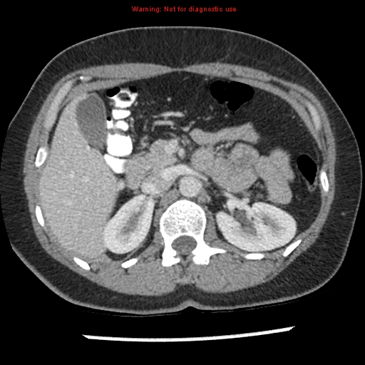File:Acute appendicitis (Radiopaedia 7966-8812 C+ portal venous phase 11).jpg