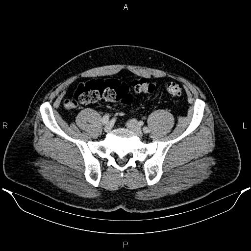 Acute appendicitis (Radiopaedia 84780-100240 Axial C+ portal venous phase 81).jpg