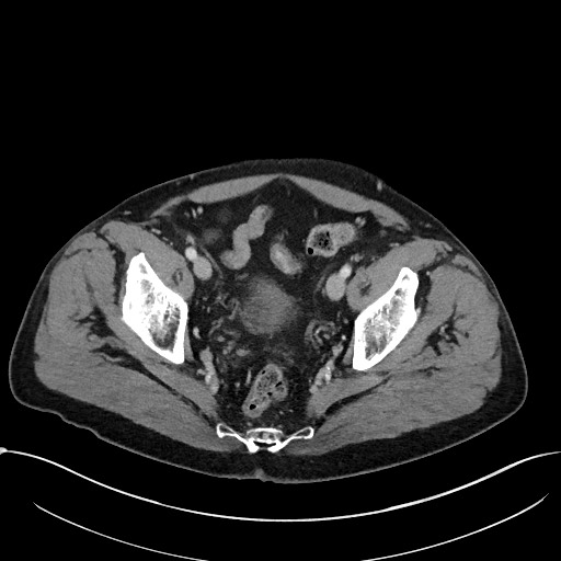 File:Acute appendicitis - large appendicoliths (Radiopaedia 61805-69820 Axial C+ portal venous phase 113).jpg