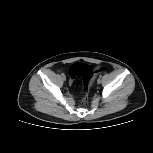 File:Acute appendicitis and COVID 19 pneumonia (Radiopaedia 76604-88380 Axial non-contrast 107).jpg