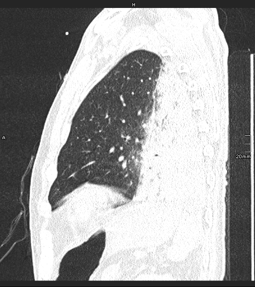 File:Acute aspiration pneumonitis (Radiopaedia 55642-62166 Sagittal lung window 28).jpg
