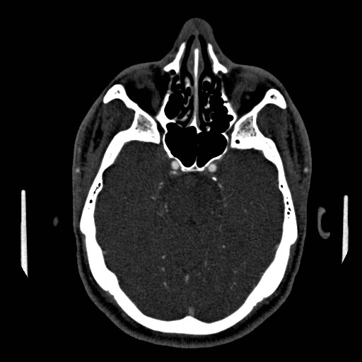 Acute basilar artery occlusion (Radiopaedia 43582-46985 Axial C+ arterial phase 54).jpg