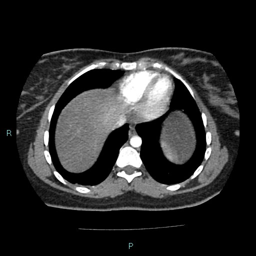 Acute bilateral pyelonephritis (Radiopaedia 37146-38881 Axial C+ arterial phase 8).jpg