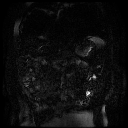 Acute cholecystitis and biliary hamartomas (Radiopaedia 86231-102240 E 141).jpg