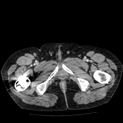 Acute cholecystitis and incidental left sided IVC (Radiopaedia 49352-54459 Axial C+ portal venous phase 166).jpg