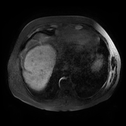 File:Acute cholecystitis complicated by pylephlebitis (Radiopaedia 65782-74915 Axial T1 fat sat 1).jpg