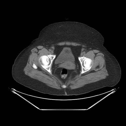 File:Acute cholecystitis with tensile fundus sign (Radiopaedia 71394-81723 Axial 88).jpg