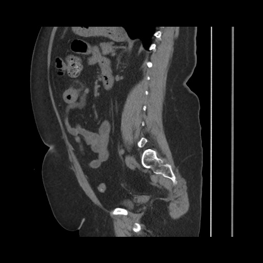 File:Acute cholecystitis with tensile fundus sign (Radiopaedia 71394-81723 Sagittal non-contrast 102).jpg