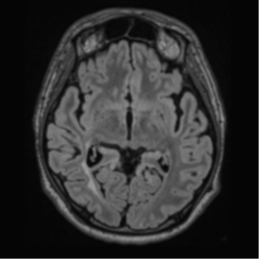 Acute disseminated encephalomyelitis (ADEM)- Anti-NMDA receptor encephalitis (Radiopaedia 54920-61201 Axial FLAIR 31).png
